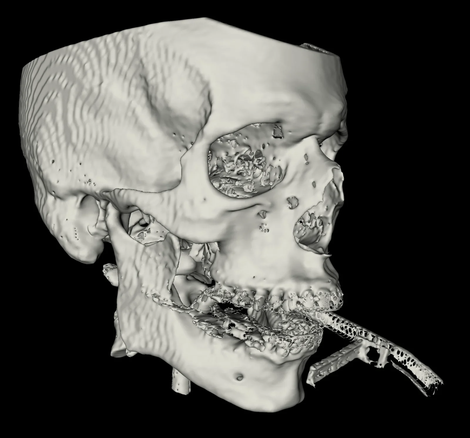 Greyscale 3D-reconstructed skull segmented from CT data, rebuilt as a printable mesh